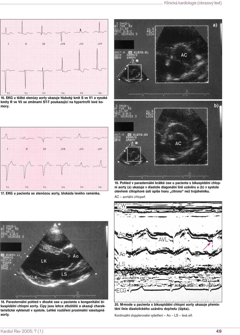 Pohled v parasternální krátké ose u pacienta s bikuspidální chlopní aorty ( ukazuje v diastole diagonální linii uzávěru a ( v systole otevřené chlopňové ústí spíše tvaru citronu než trojúhelníku.
