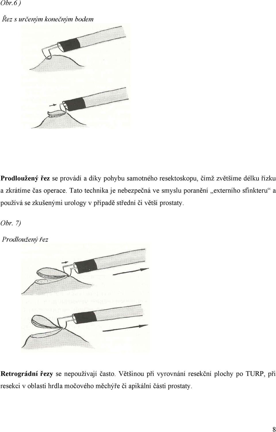 Tato technika je nebezpečná ve smyslu poranění externího sfinkteru a používá se zkušenými urology v případě střední