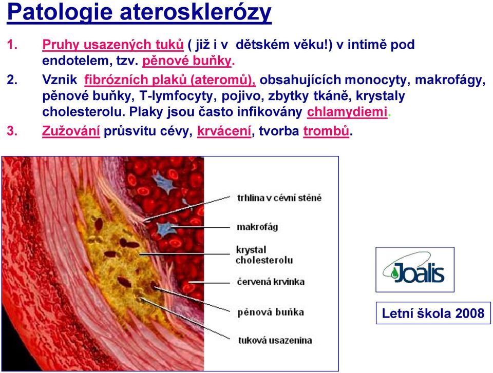 Vznik fibrózních plaků (ateromů), obsahujících monocyty, makrofágy, pěnové buňky,