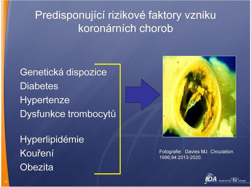 Dysfunkce trombocytů Hyperlipidémie Kouření Obezita