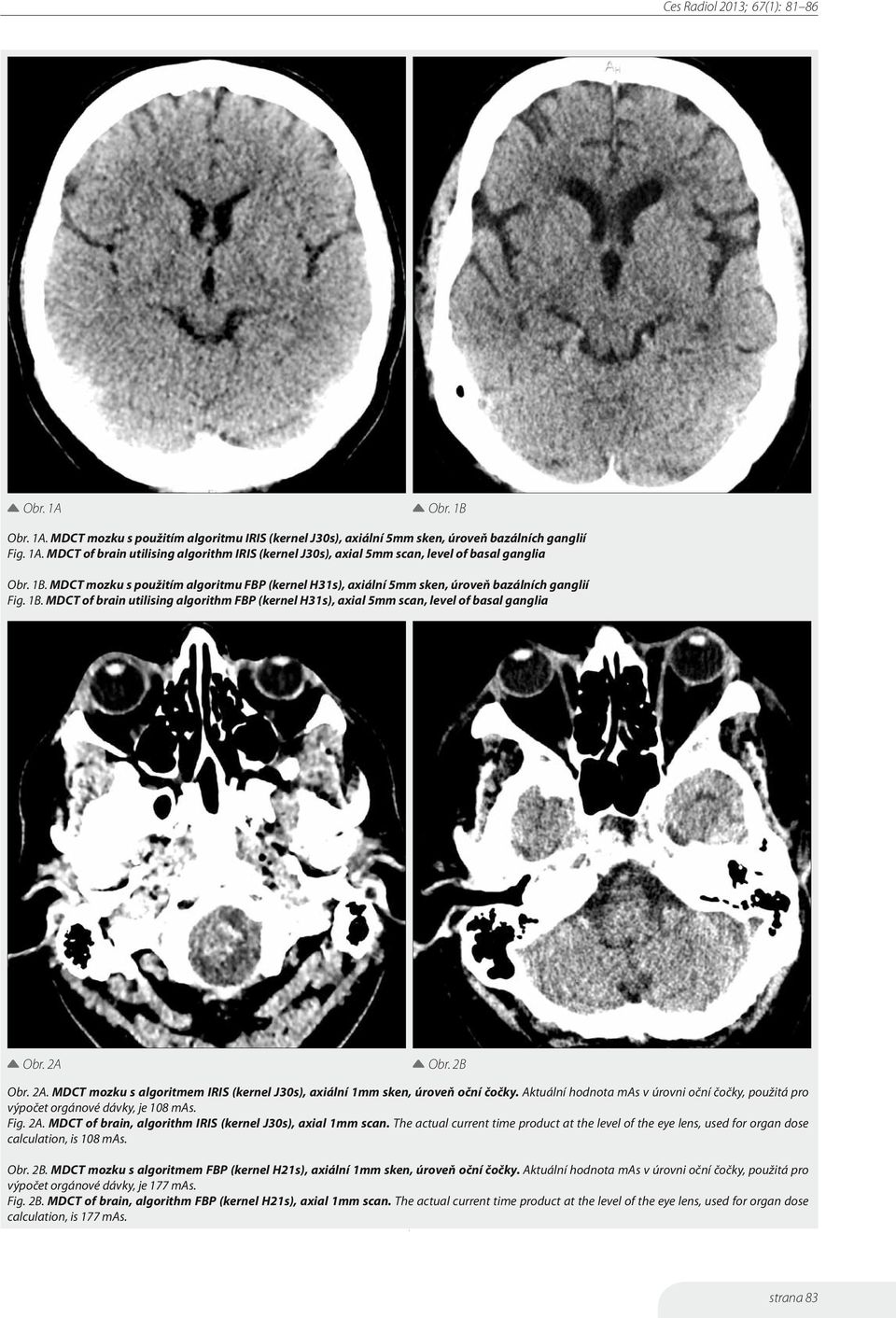 MDCT of brain utilising algorithm FBP (kernel H31s), axial 5mm scan, level of basal ganglia Obr. 2A Obr. 2B Obr. 2A. MDCT mozku s algoritmem IRIS (kernel J30s), axiální 1mm sken, úroveň oční čočky.