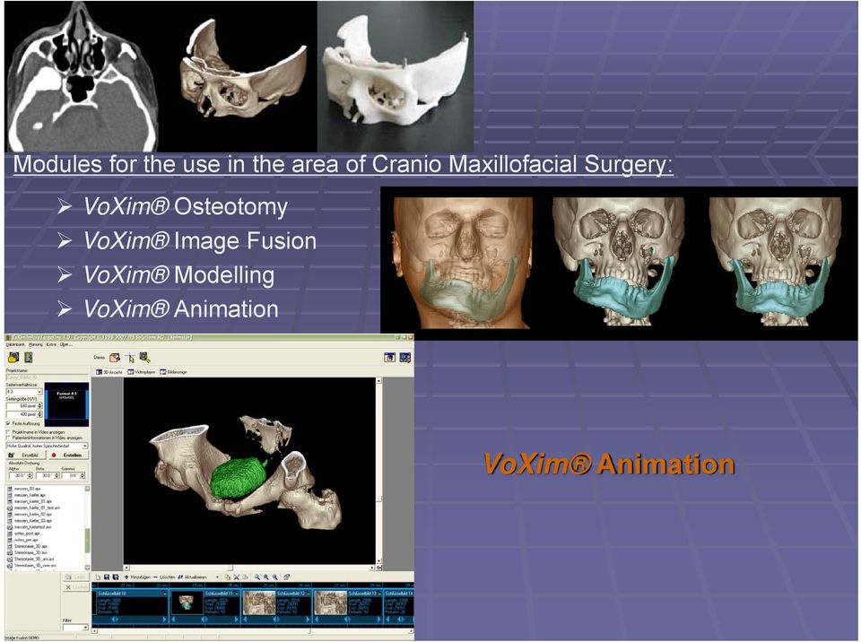 Osteotomy VoXim Image Fusion VoXim