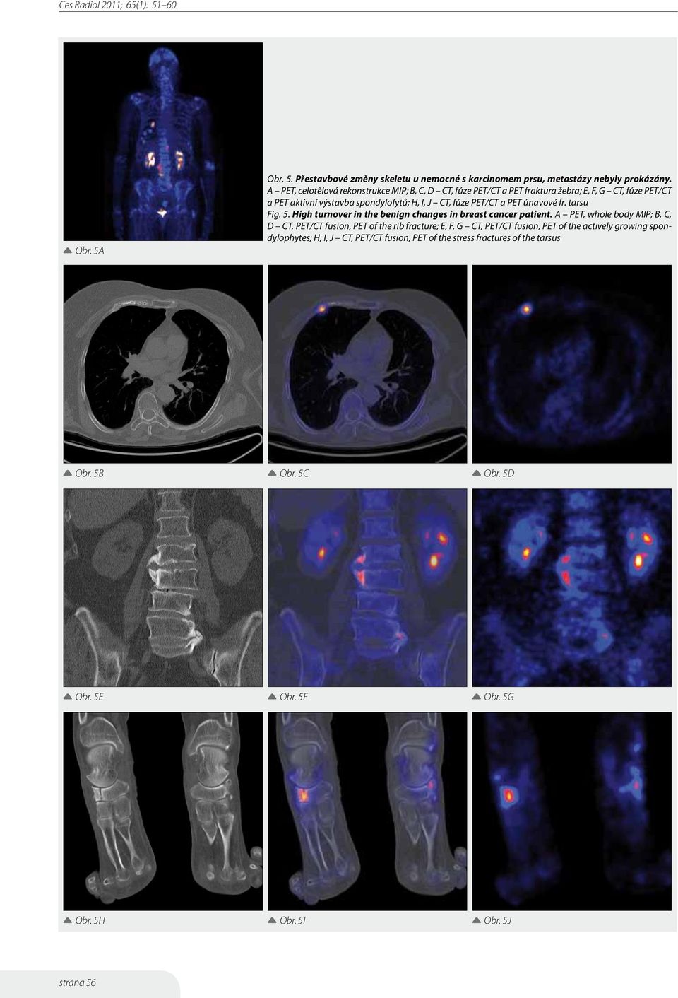 PET/CT a PET únavové fr. tarsu Fig. 5. High turnover in the benign changes in breast cancer patient.
