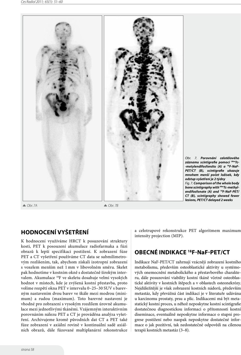 využíváme HRCT k posuzování struktury kosti, PET k posouzení akumulace radiofarmaka a fúzi obrazů k lepší specifikaci postižení.