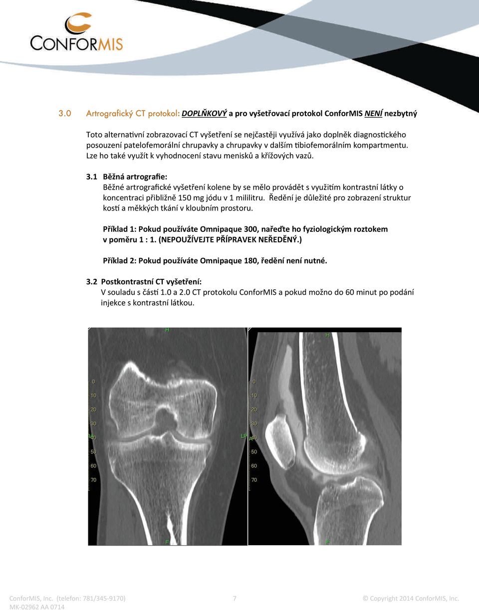 1 Běžná artrografie: Běžné artrografické vyšetření kolene by se mělo provádět s využi m kontrastní látky o koncentraci přibližně 150 mg jódu v 1 mililitru.