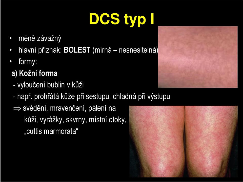 např. prohřátá kůže při sestupu, chladná při výstupu svědění,