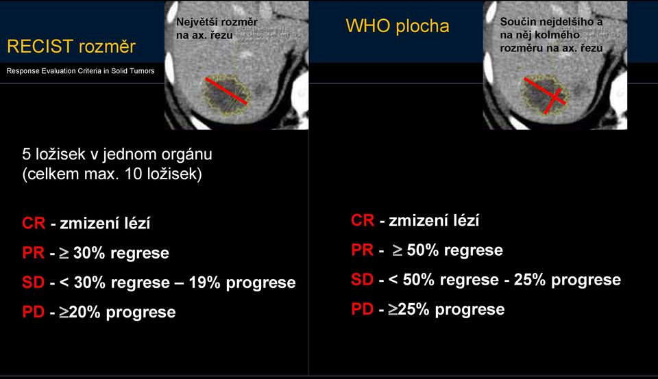 řezu Response Evaluation Criteria in Solid Tumors 5 ložisek v jednom orgánu (celkem max.