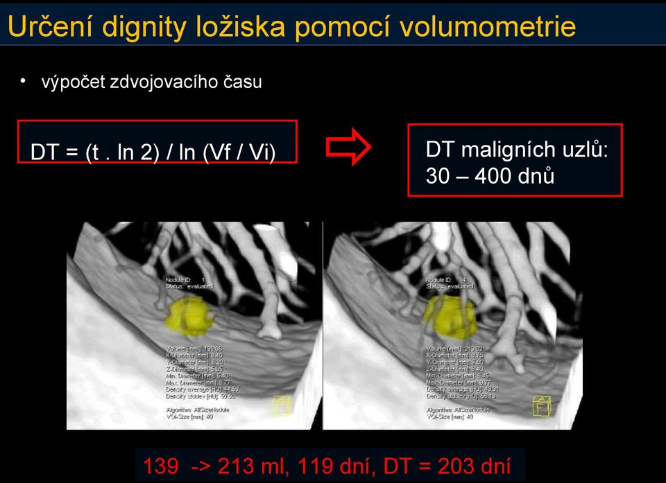 = (t. ln 2) / ln (Vf / Vi) DT maligních