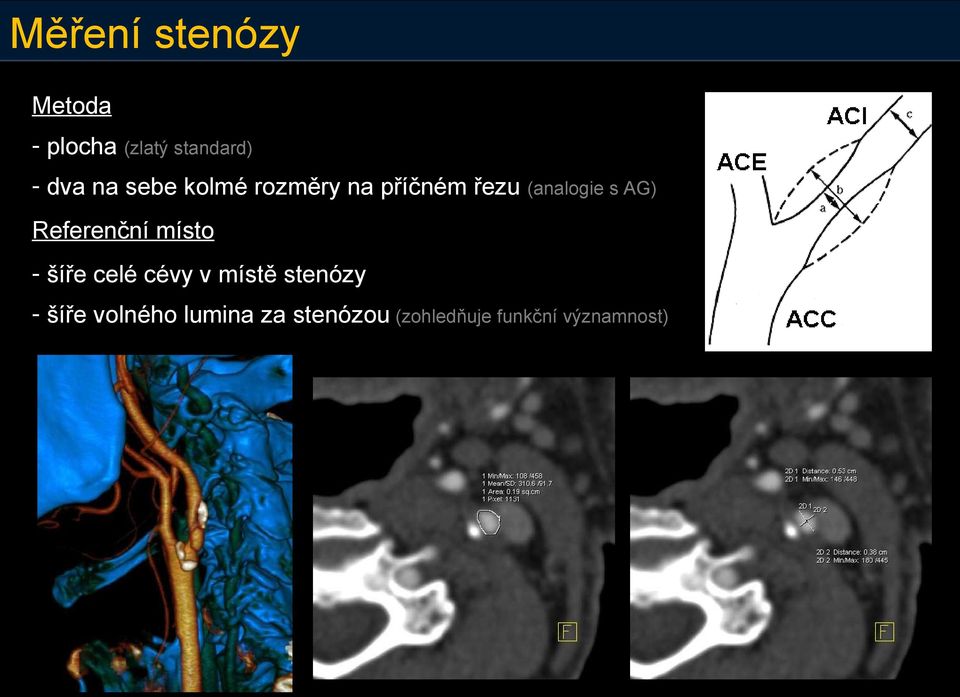 Referenční místo - šíře celé cévy v místě stenózy -