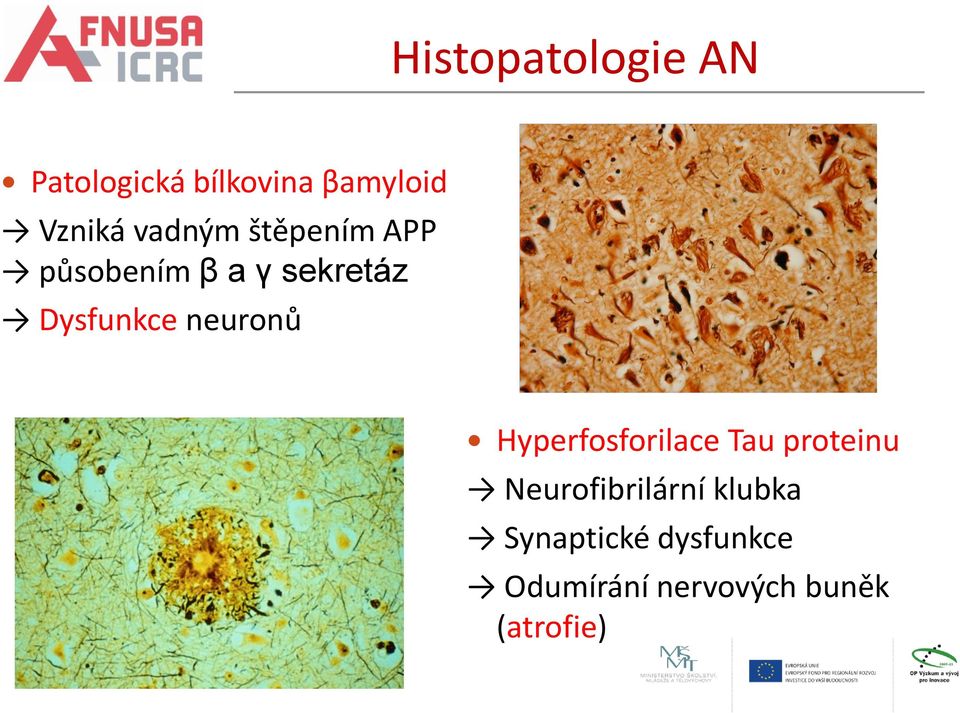 neuronů Hyperfosforilace Tau proteinu Neurofibrilární