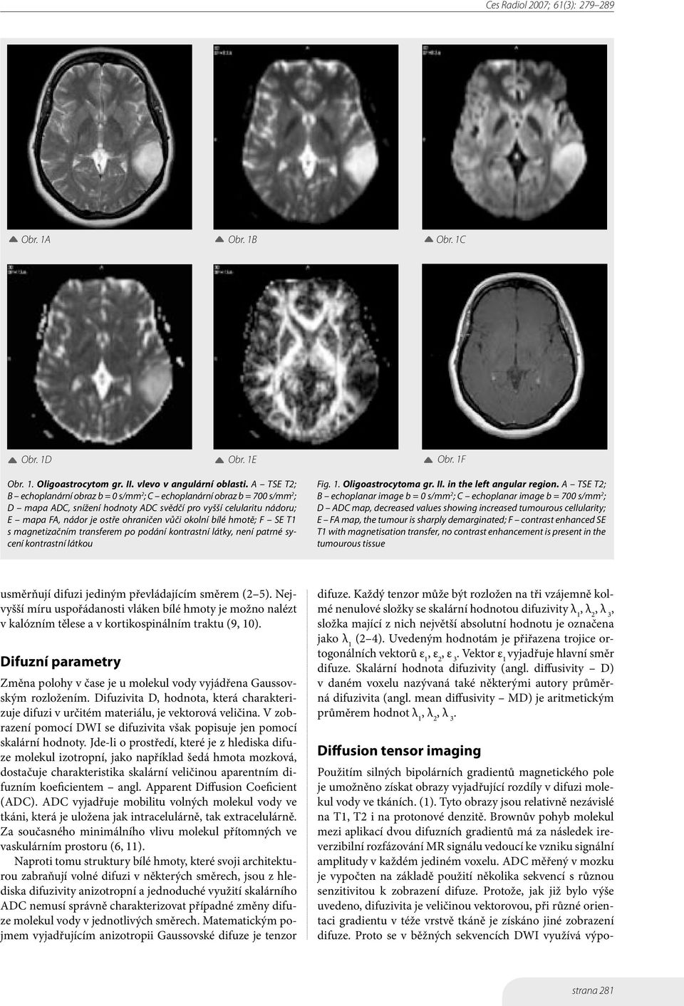 bílé hmotě; F SE T1 s magnetizačním transferem po podání kontrastní látky, není patrné sycení kontrastní látkou Fig. 1. Oligoastrocytoma gr. II. in the left angular region.