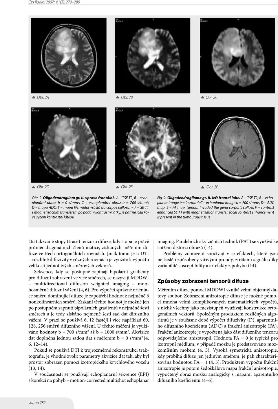 látky, je patrné ložiskové sycení kontrastní látkou Fig. 2. Oligodendroglioma gr. II. left frontal lobe.
