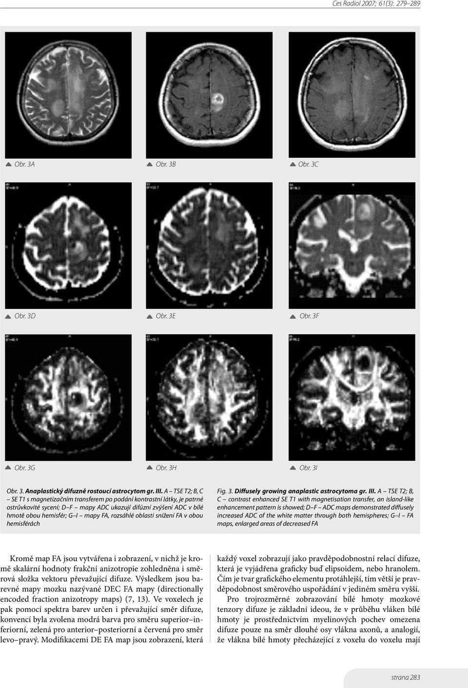 oblasti snížení FA v obou hemisférách Fig. 3. Diffusely growing anaplastic astrocytoma gr. III.