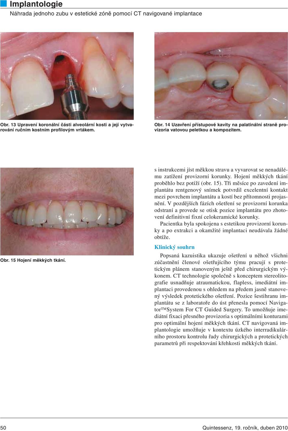 Hojení měkkých tkání proběhlo bez potíží (obr. 15). Tři měsíce po zavedení implantátu rentgenový snímek potvrdil excelentní kontakt mezi povrchem implantátu a kostí bez přítomnosti projasnění.