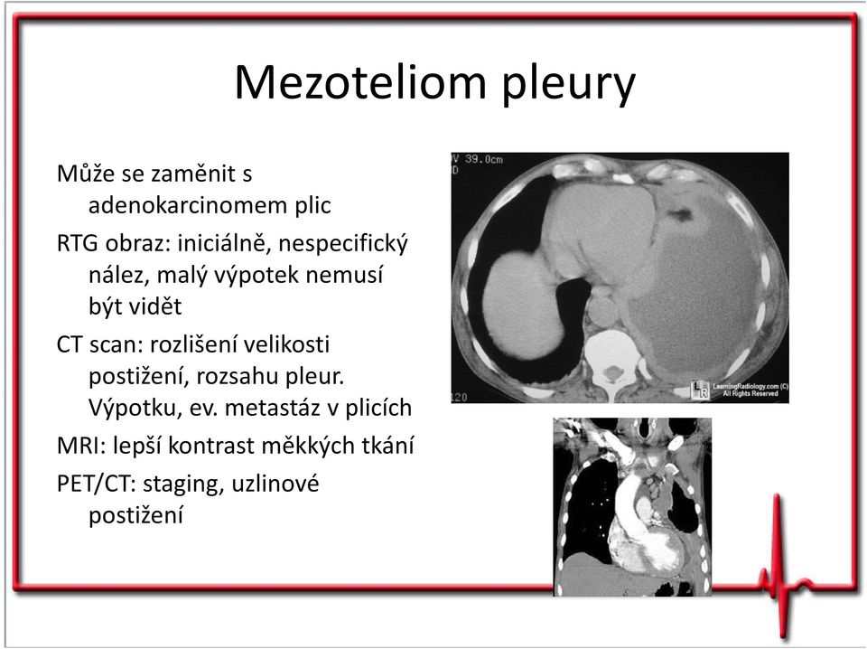rozlišení velikosti postižení, rozsahu pleur. Výpotku, ev.