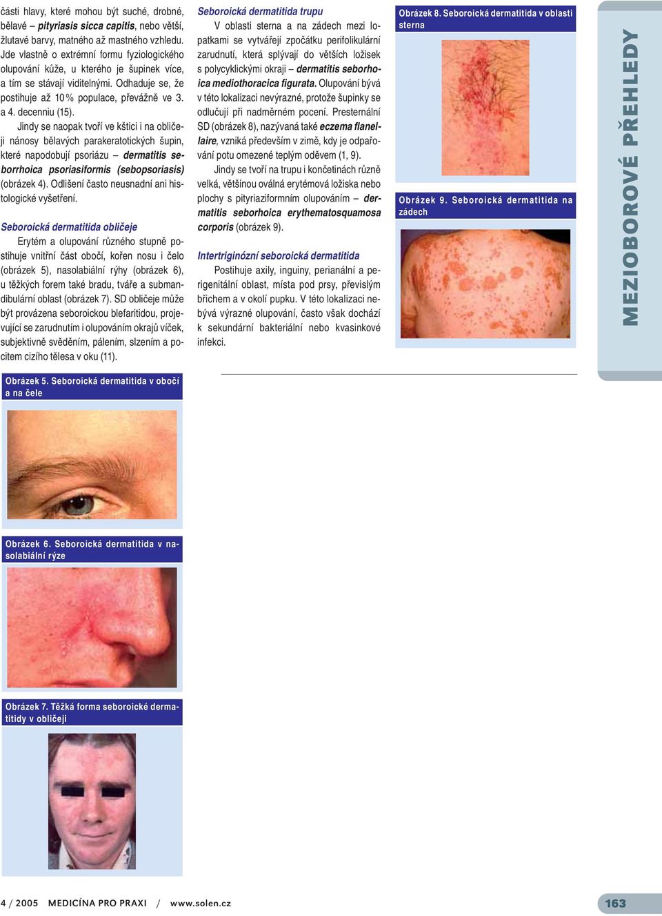 Jindy se naopak tvoří ve kštici i na obličeji nánosy bělavých parakeratotických šupin, které napodobují psoriázu dermatitis seborrhoica psoriasiformis (sebopsoriasis) (obrázek 4).