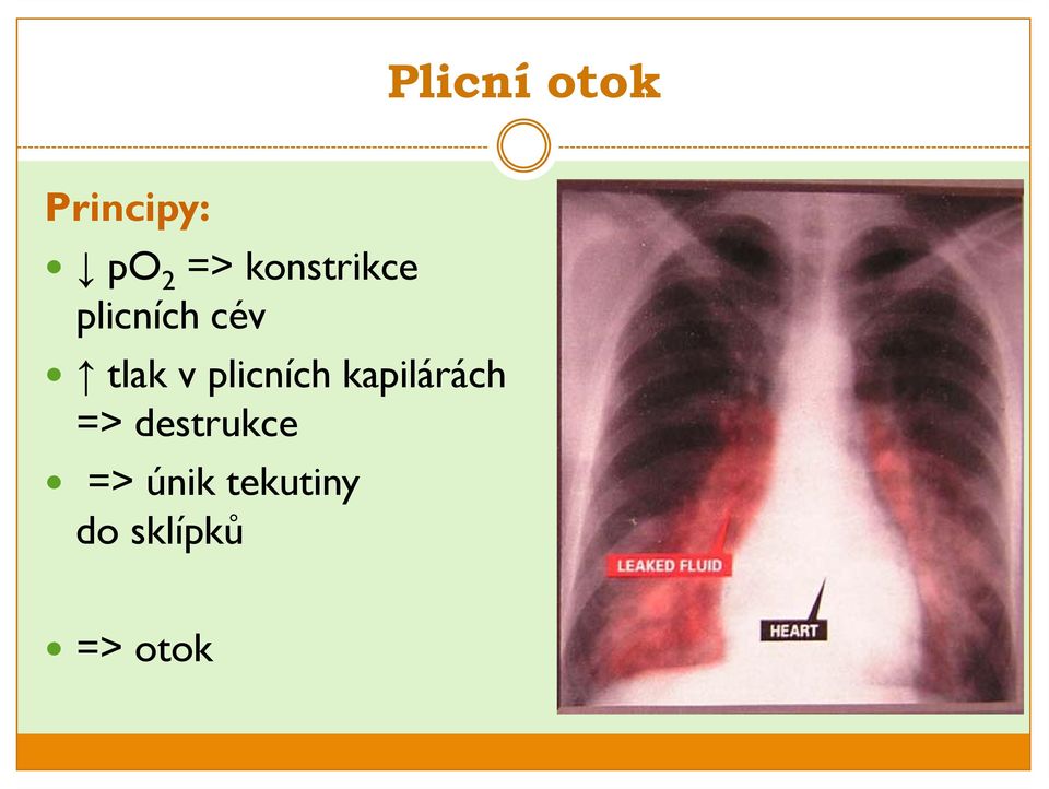 plicních kapilárách => destrukce