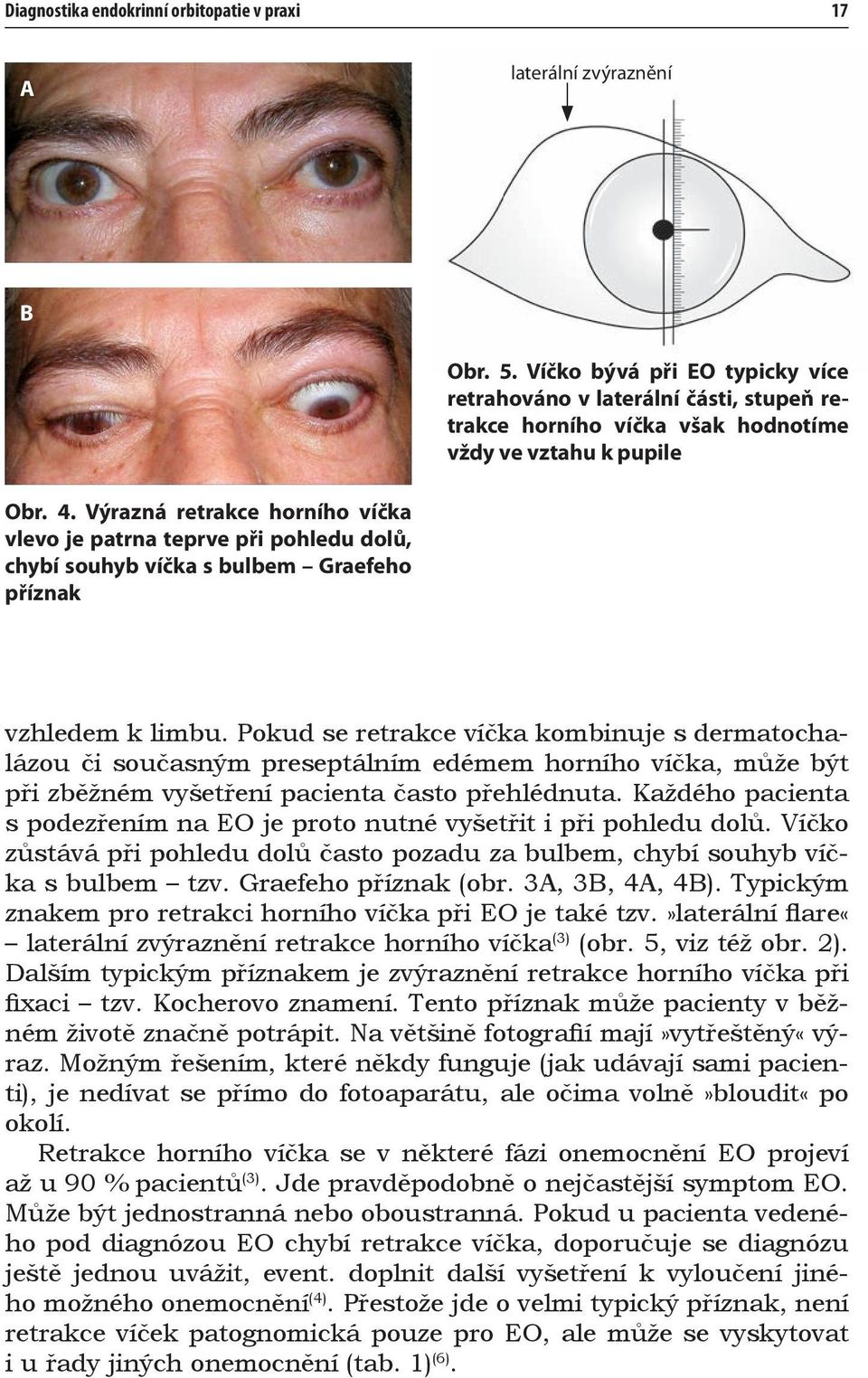 Výrazná retrakce horního víčka vlevo je patrna teprve při pohledu dolů, chybí souhyb víčka s bulbem Graefeho příznak vzhledem k limbu.