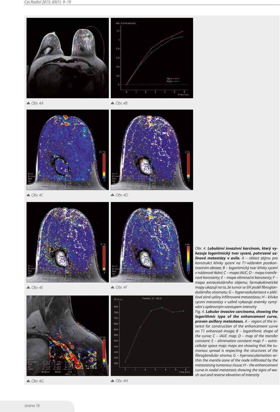 konstanty; F mapa extracelulárního objemu; farmakokinetické mapy ukazují na to, že tumor se šíří podél fibroglandulárního stromatu; G hypervaskularizace v plášťové zóně uzliny infiltrované