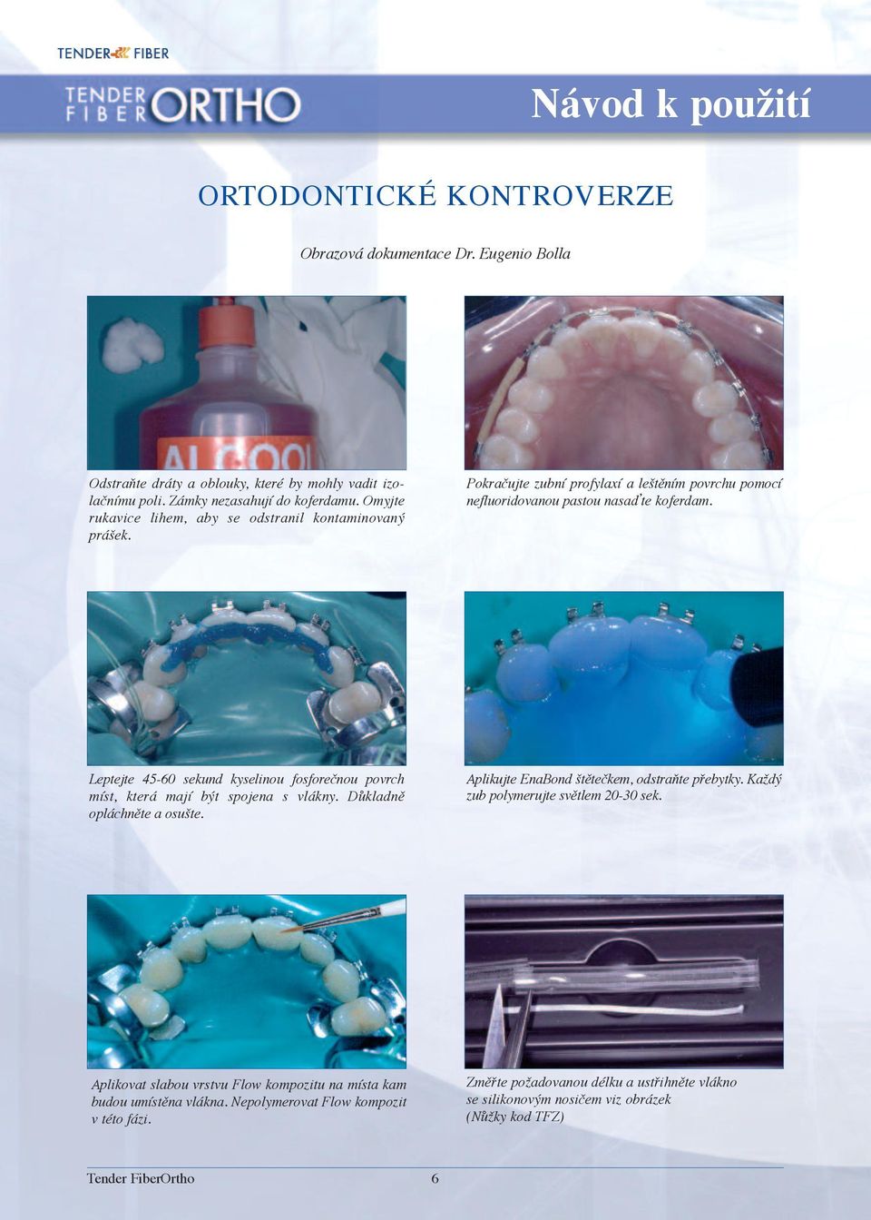 Leptejte 45-60 sekund kyselinou fosforečnou povrch míst, která mají být spojena s vlákny. Důkladně opláchněte a osušte. Aplikujte EnaBond štětečkem, odstraňte přebytky.