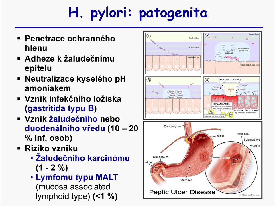 Vznik žaludečního nebo duodenálního vředu (10 20 % inf.