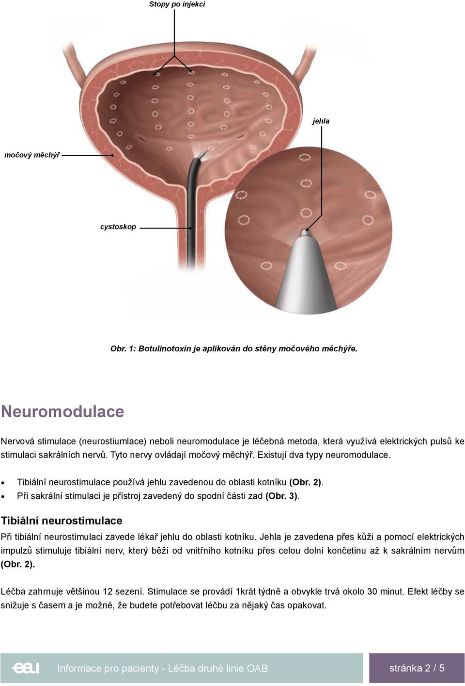 Existují dva typy neuromodulace. Tibiální neurostimulace používá jehlu zavedenou do oblasti kotníku (Obr. 2). Při sakrální stimulaci je přístroj zavedený do spodní části zad (Obr. 3).