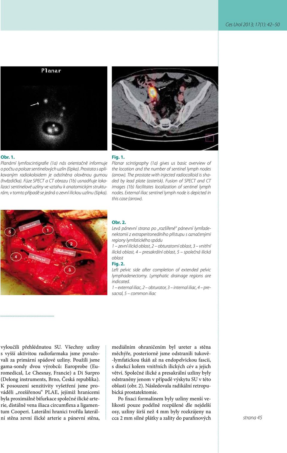Planar scintigraphy (1a) gives us basic overview of the location and the number of sentinel lymph nodes (arrow). The prostate with injected radiocolloid is shaded by lead plate (asterisk).