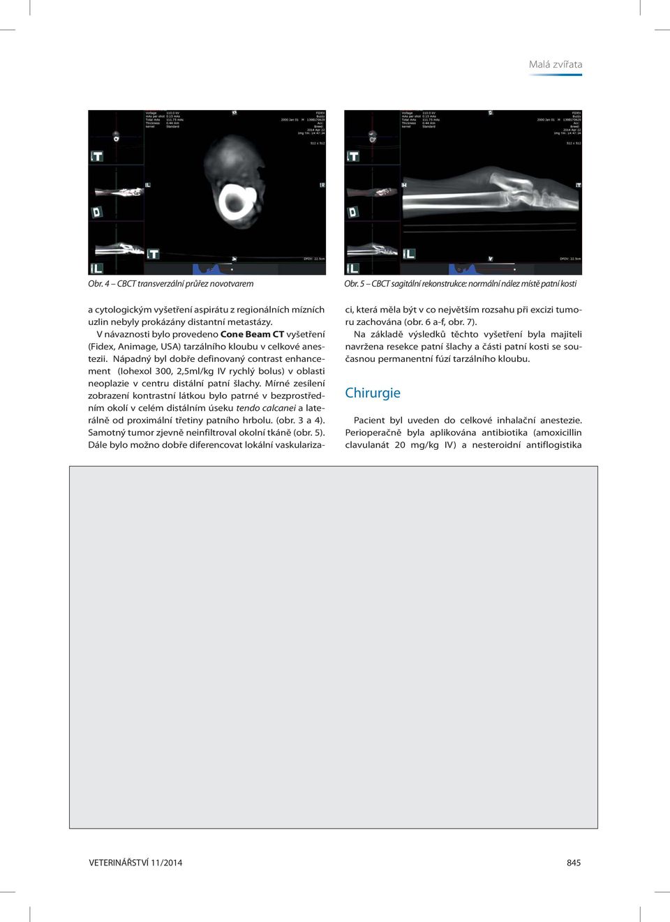 V návaznosti bylo provedeno Cone Beam CT vyšetření (Fidex, Animage, USA) tarzálního kloubu v celkové anestezii.
