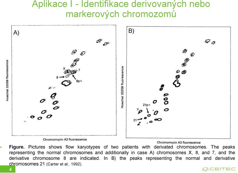 The peaks representing the normal chromosomes and additionally in case A) chromosomes X, 8, and 7,