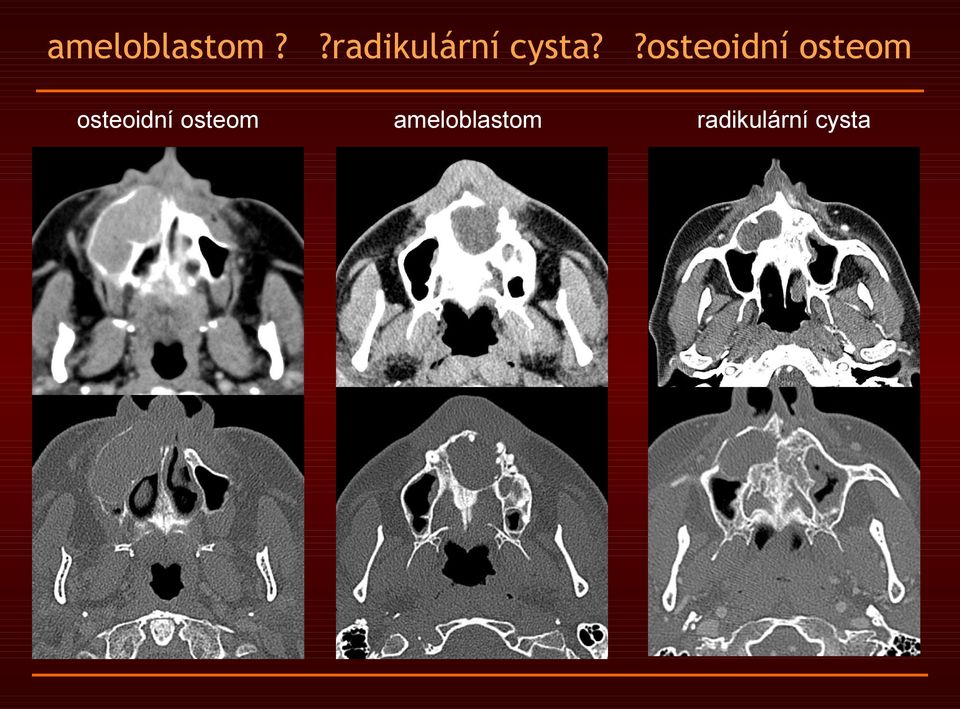 ?osteoidní osteom