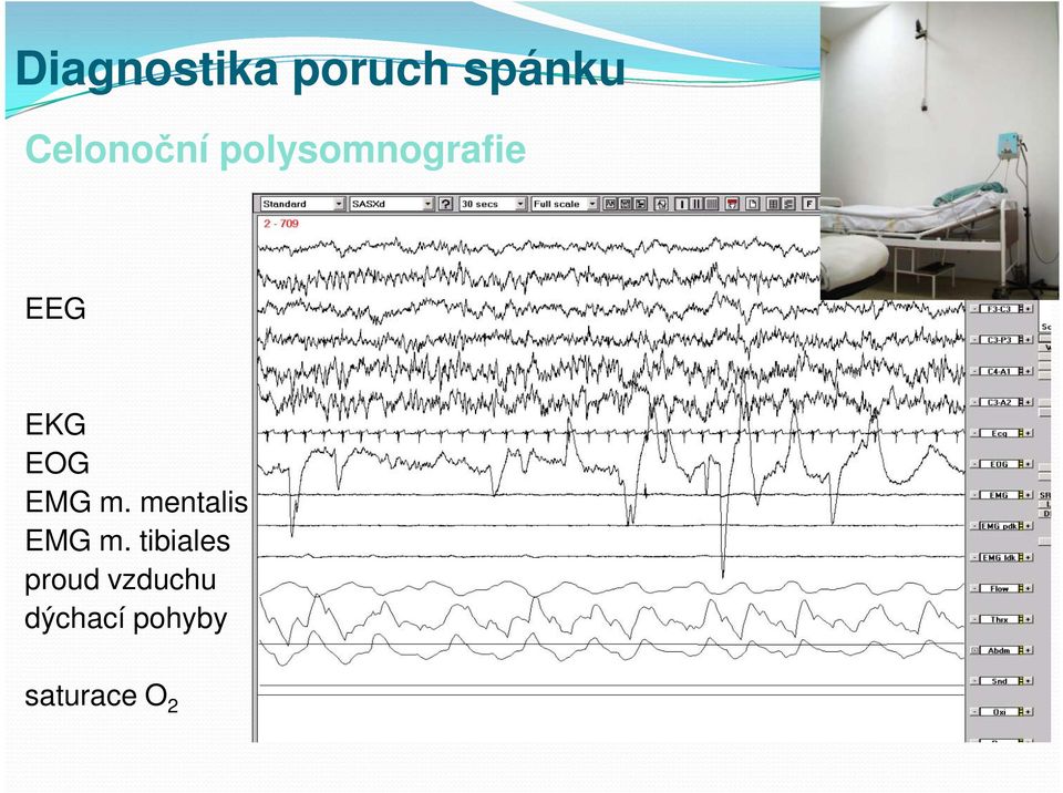 EOG EMG m. mentalis EMG m.