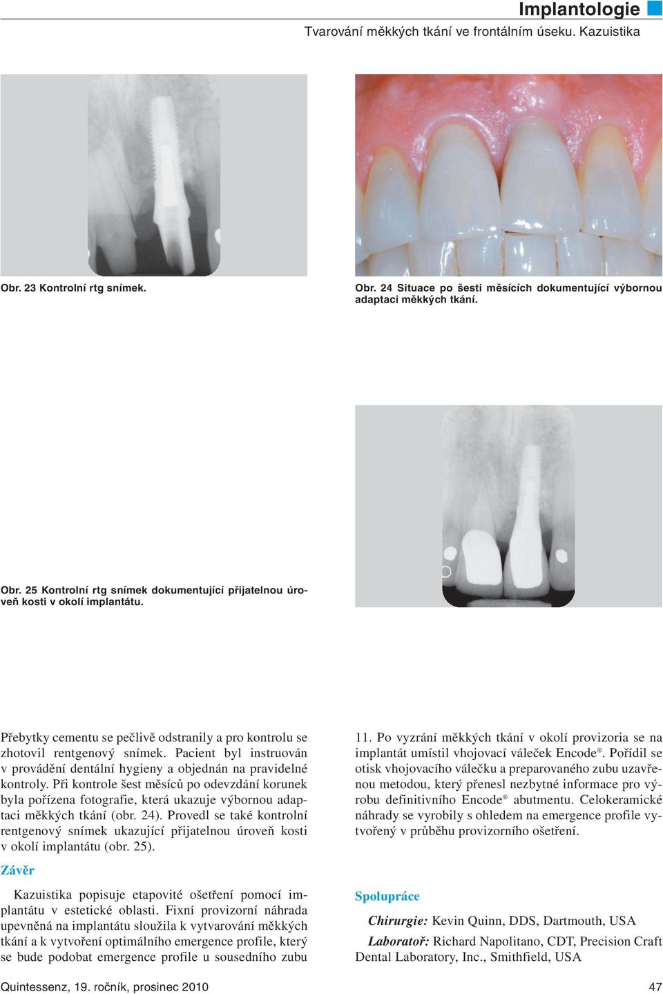 Při kontrole šest měsíců po odevzdání korunek byla pořízena fotografie, která ukazuje výbornou adaptaci měkkých tkání (obr. 24).