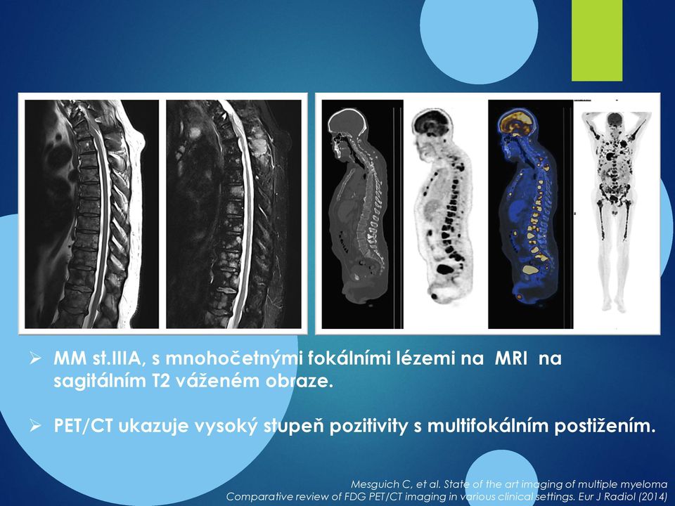 PET/CT ukazuje vysoký stupeň pozitivity s multifokálním postižením.