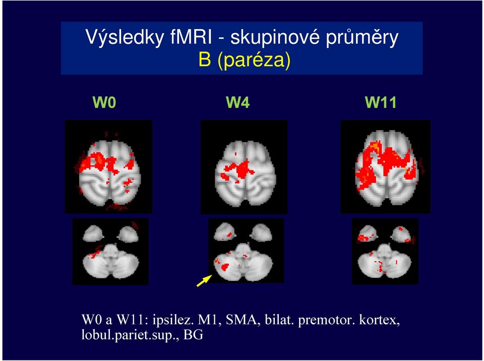 a W11: ipsilez. M1, SMA, bilat.