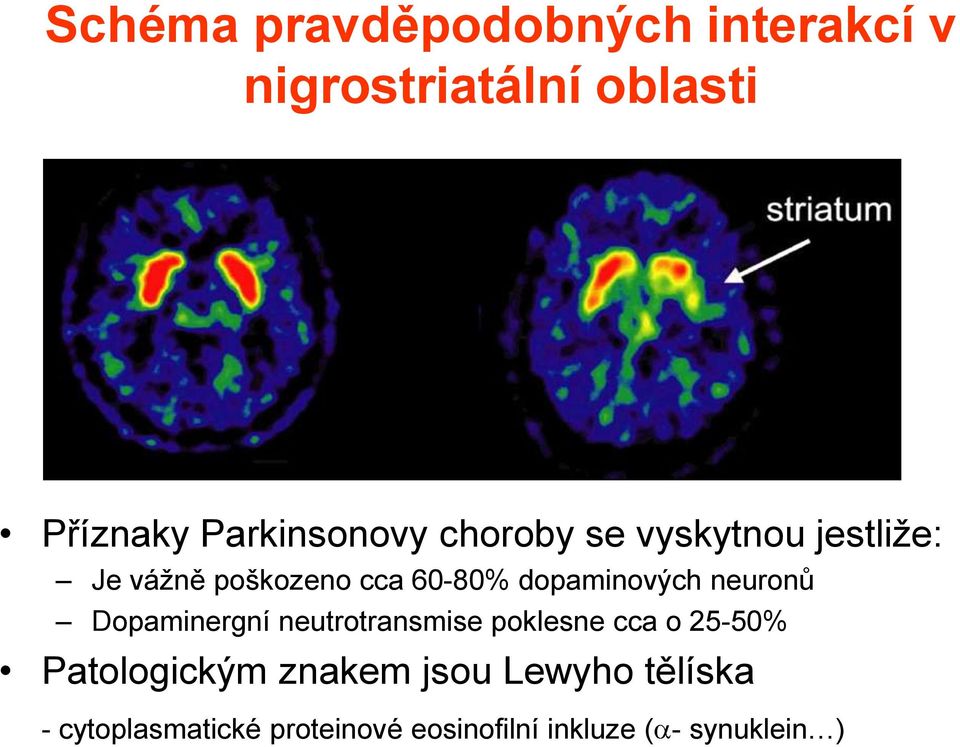 dopaminových neuronů Dopaminergní neutrotransmise poklesne cca o 25-50%