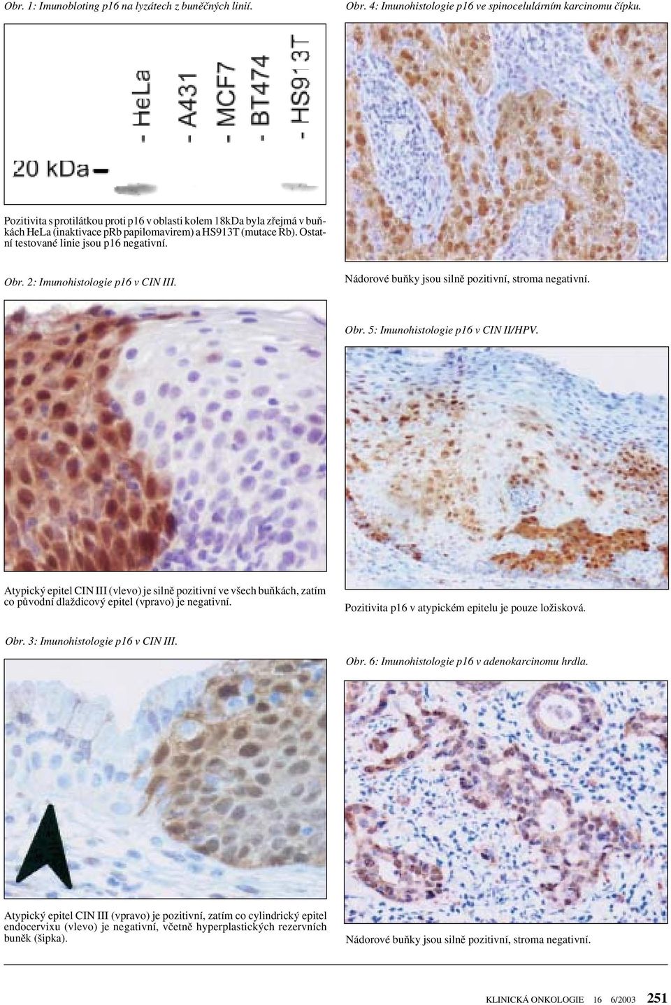 2: Imunohistologie p16 v CIN III. Nádorové buàky jsou silnû pozitivní, stroma negativní. Obr. 5: Imunohistologie p16 v CIN II/HPV.