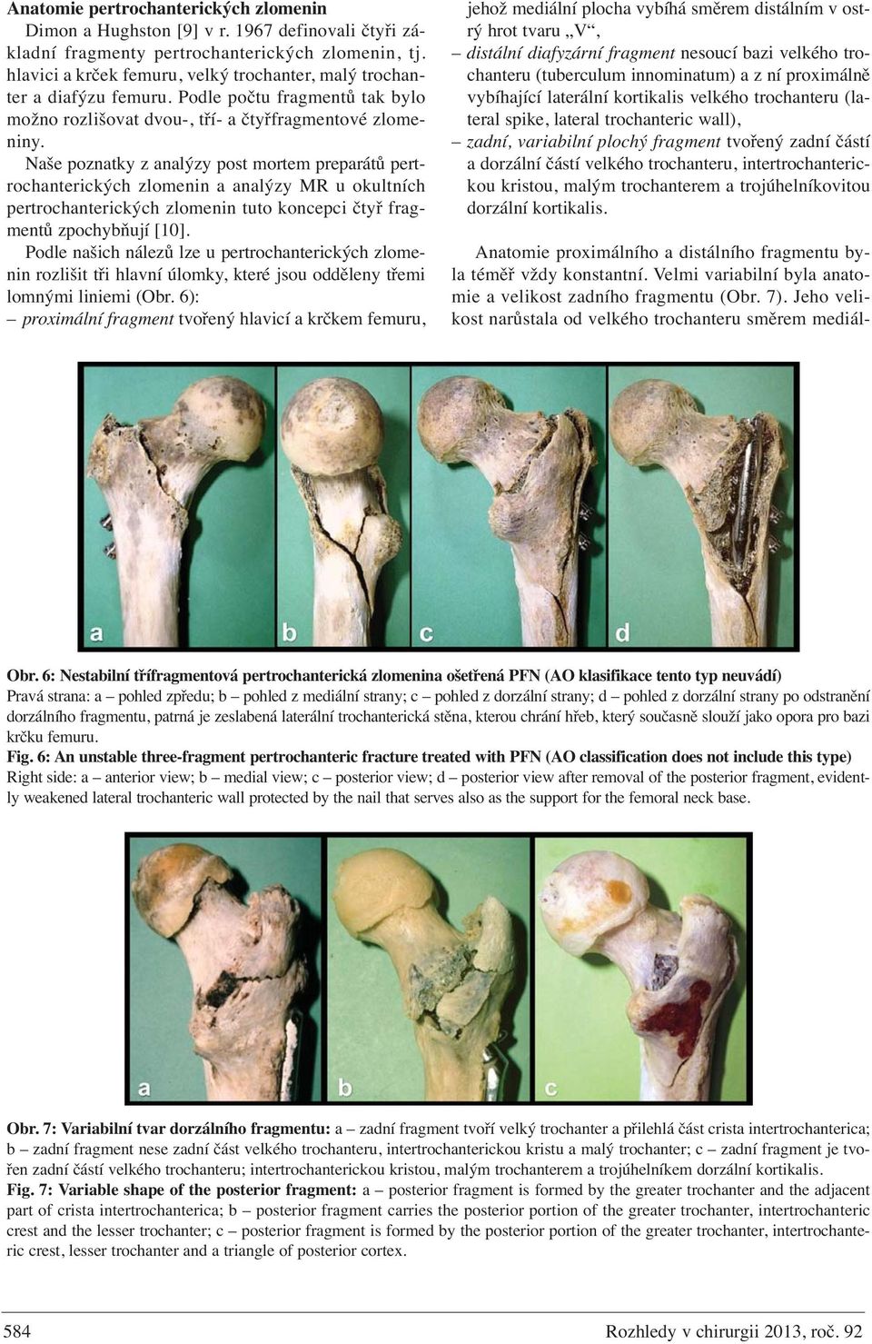 Naše poznatky z analýzy post mortem preparátů pertrochanterických zlomenin a analýzy MR u okultních pertrochanterických zlomenin tuto koncepci čtyř fragmentů zpochybňují [10].