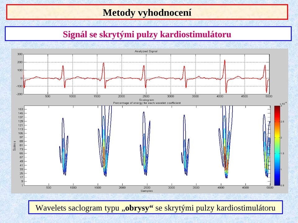 kardiostimulátoru Wavelets