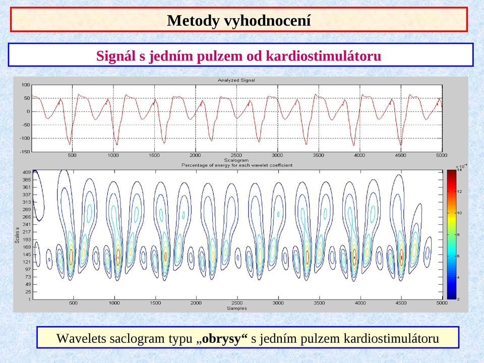 kardiostimulátoru Wavelets
