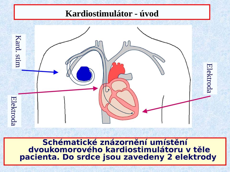 umístění dvoukomorového kardiostimulátoru
