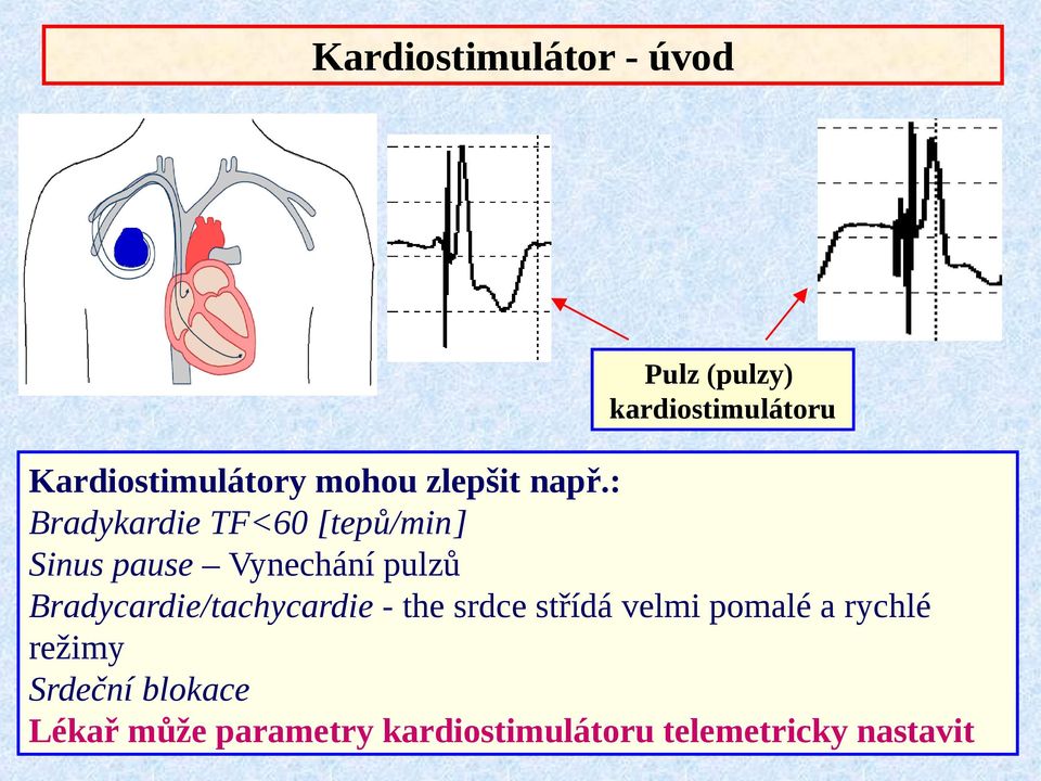 Elektronický systém a programové vybavení pro detekci a optimalizaci pulzů  kardiostimulátoru - PDF Stažení zdarma