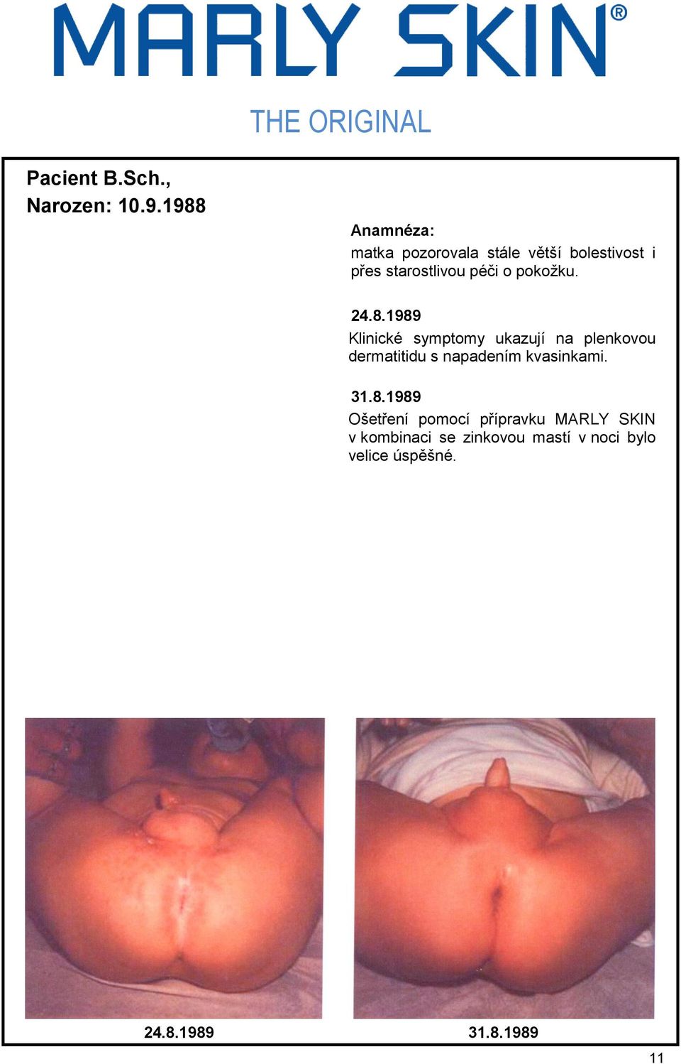 24.8.1989 Klinické symptomy ukazují na plenkovou dermatitidu s napadením