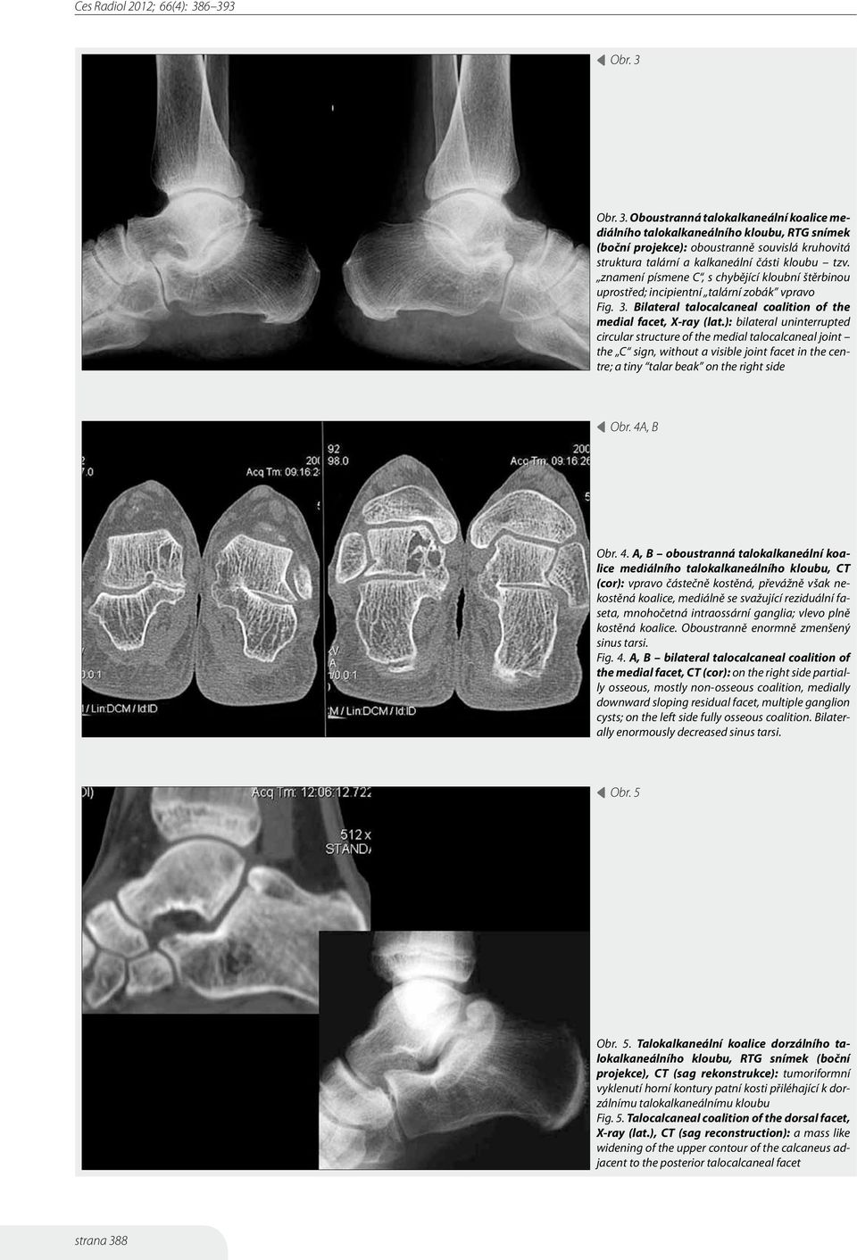 ): bilateral uninterrupted circular structure of the medial talocalcaneal joint the C sign, without a visible joint facet in the centre; a tiny talar beak on the right side Obr. 4A