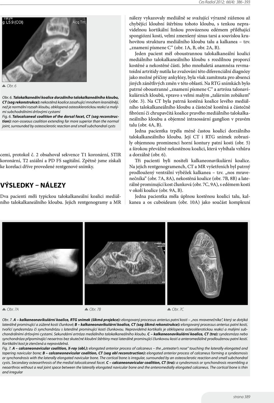 Talokalkaneální koalice dorzálního talokalkaneálního kloubu, CT (sag rekonstrukce): nekostěná koalice zasahující mnohem kraniálněji, než je normální rozsah kloubu, obklopená osteosklerotickou reakcí