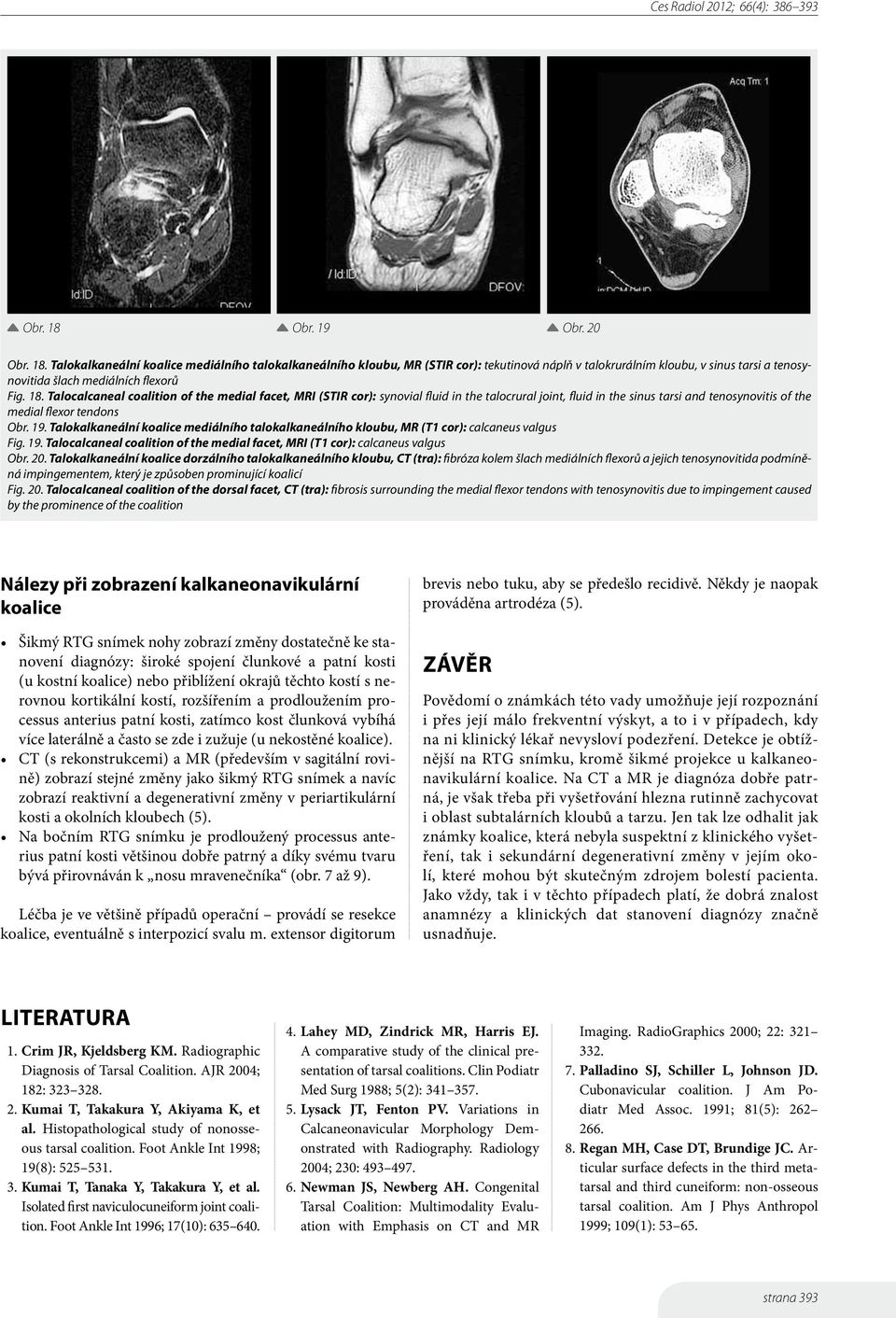 Talokalkaneální koalice mediálního talokalkaneálního kloubu, MR (T1 cor): calcaneus valgus Fig. 19. Talocalcaneal coalition of the medial facet, MRI (T1 cor): calcaneus valgus Obr. 20.
