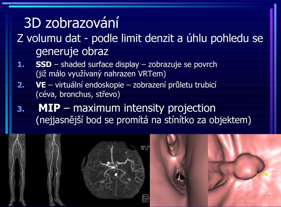 VRTem) VE virtuální endoskopie zobrazení průletu trubicí (céva, bronchus, střevo)