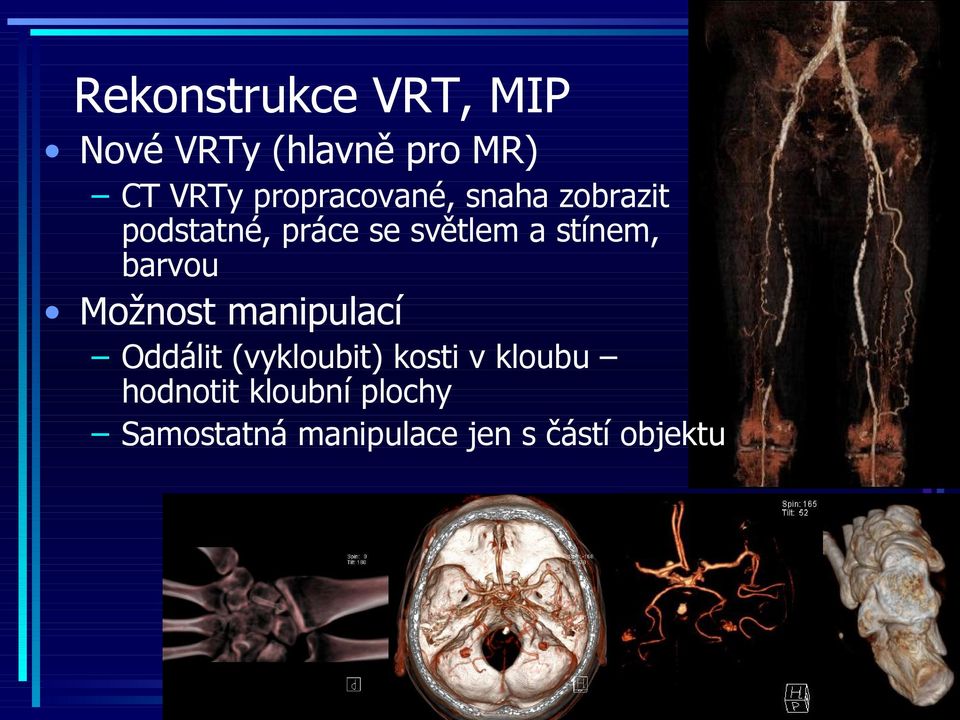 stínem, barvou Možnost manipulací Oddálit (vykloubit) kosti v