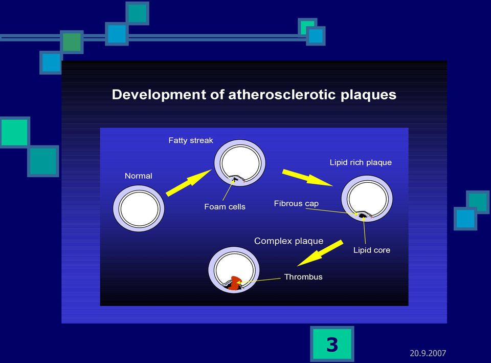 rich plaque Foam cells Fibrous