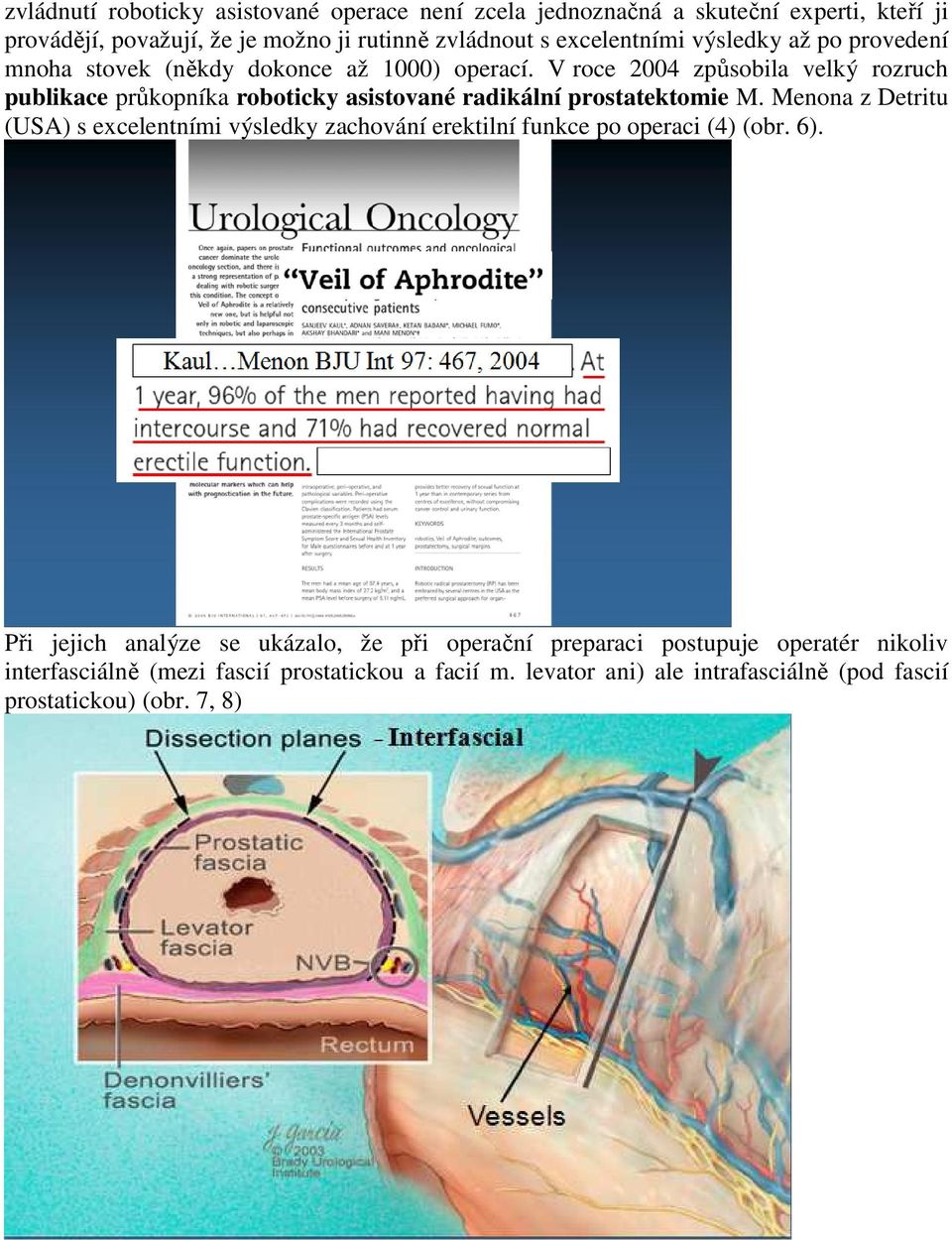 V roce 2004 způsobila velký rozruch publikace průkopníka roboticky asistované radikální prostatektomie M.