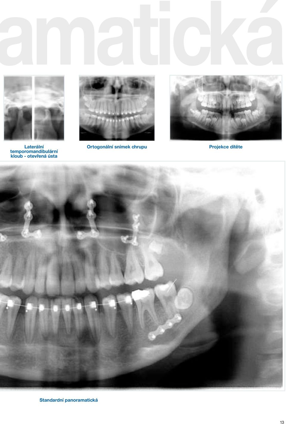 Orthoralix Panoramatický rentgen. Panoramatický a cefalometrický systém s  širokou škálou výhod - PDF Free Download